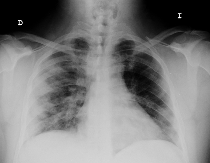 La imagen corresponde a una radiografía de tórax en proyección posteroanterior (PA). Se observa un patrón de opacidades pulmonares bilaterales de predominio en los campos inferiores, con aspecto reticular y consolidativo, compatible con un proceso inflamatorio o infeccioso. Dichas opacidades pueden corresponder a una neumonía viral, como en el contexto de la influenza A (H1N1).