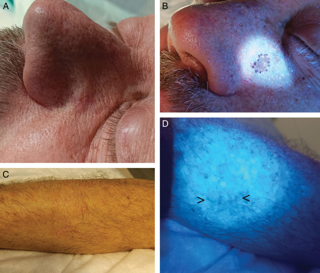 La lámpara de Wood es un dispositivo utilizado en dermatología que emite luz ultravioleta (UV) en una longitud de onda específica (alrededor de 365 nm). Esta herramienta es útil para diagnosticar y evaluar diversas afecciones de la piel, cabello y uñas, ya que ciertas sustancias o microorganismos emiten fluorescencia bajo esta luz, lo que permite identificarlos más fácilmente.