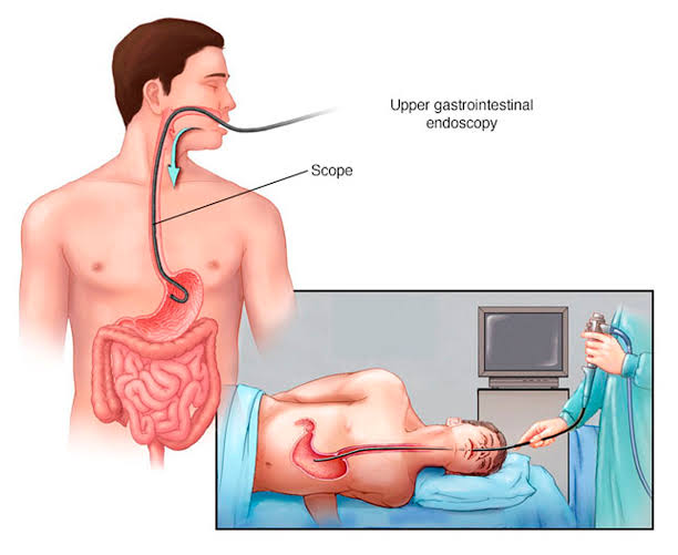 Endoscopia alta en proceso: Visualización del esófago, estómago y duodeno con un endoscopio flexible para diagnóstico y tratamiento de enfermedades digestivas.