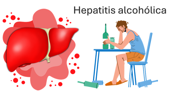 Hepatitis alcohólica en México: una enfermedad prevenible pero con alta mortalidad. Afecta principalmente a personas con consumo crónico de alcohol y es una de las principales causas de insuficiencia hepática en el país. La detección temprana y la abstinencia son clave para mejorar el pronóstico.