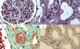 Trasplante Renal: Consideraciones Claves