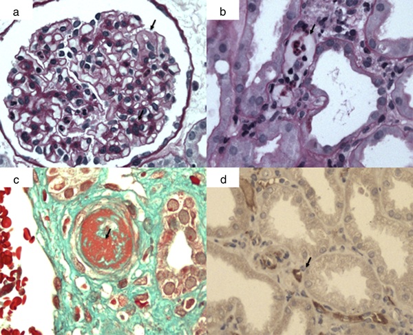 Biopsia renal de un injerto rechazado.

(a) Glomerulitis con infiltrado de células inflamatorias en los capilares glomerulares (tinción PAS).
(b) Endotelitis con inflamación en los capilares peritubulares (tinción H&E).
(c) Fibrosis intersticial y atrofia tubular en un rechazo crónico (tinción tricrómica de Masson).
(d) Depósitos de C4d en los capilares peritubulares, indicativos de rechazo mediado por anticuerpos (tinción inmunohistoquímica para C4d).

Esta imagen muestra hallazgos histopatológicos clave en distintos tipos de rechazo de injerto renal, esenciales para su diagnóstico y manejo clínico.