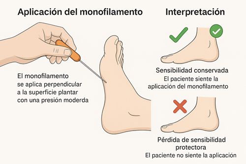 Ilustración del uso clínico del monofilamento de 10 g (Semmes-Weinstein) para evaluar la sensibilidad protectora en el pie. Se muestra la técnica correcta de aplicación y la interpretación de los resultados según la respuesta del paciente.