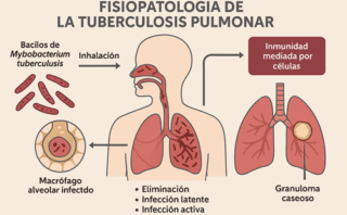Neuropatía diabética