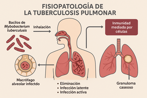 Diagrama ilustrativo de la fisiopatología de la tuberculosis pulmonar. Muestra el ingreso de bacilos de Mycobacterium tuberculosis por vía inhalatoria, su fagocitosis por macrófagos alveolares y los posibles desenlaces: eliminación, infección latente o enfermedad activa. Se incluye la formación del granuloma caseoso mediado por la respuesta inmune celular.
