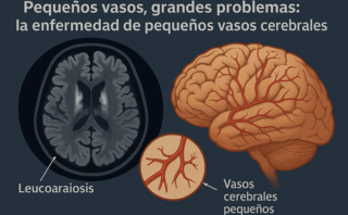 Criterios STRIVE: Evaluación de la enfermedad de pequeños vasos