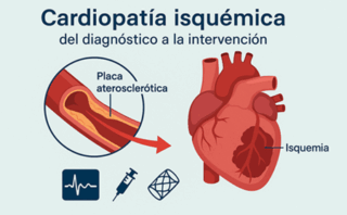 Infarto Agudo al Miocardio (IAM)