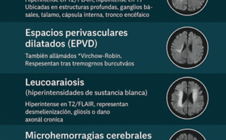 Enfermedad de pequeños vasos | Grandes problemas