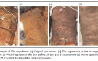 Cuidados agudos en pacientes quemados: fluidos, cirugía y actualizaciones