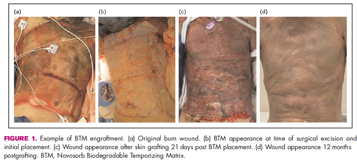 Evolución clínica de un paciente gran quemado tratado con BTM (Biodegradable Temporizing Matrix).