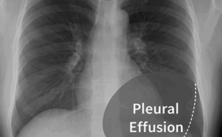 Levetiracetam y Brivaracetam: mecanismo SV2A, usos, dosis y precios en México