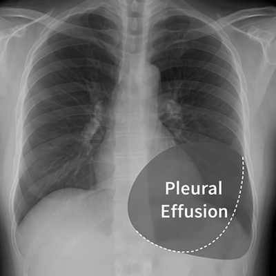 Radiografía de tórax que muestra un derrame pleural derecho, con borramiento del ángulo costofrénico y nivel líquido característico, resaltado para fines educativos.