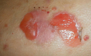 Síndrome de Piel Escaldada Estafilocócica