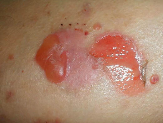 Pénfigo vulgar. Ampolla cutánea tensa sobre base eritematosa. Se observa una lesión vesiculoampollar de contenido seroso con halo inflamatorio periférico.