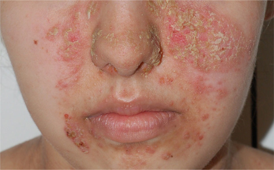 Pénfigo foliáceo. Se observan lesiones eritematosas con descamación y costras superficiales en región facial, características del pénfigo foliáceo. En esta variante de pénfigo, las ampollas son muy frágiles y se rompen rápidamente, por lo que con frecuencia se presentan como erosiones y costras superficiales más que como ampollas intactas.