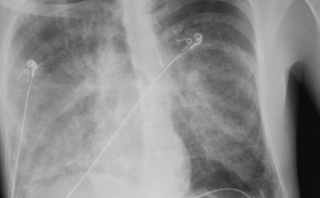 Evento Vascular Cerebral Hemorrágico: Caso Clínico