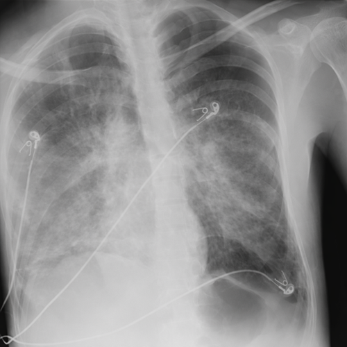 Radiografía de tórax portátil en paciente bajo ventilación mecánica, que muestra infiltrado alveolo-intersticial bilateral difuso compatible con neumonía oportunista, asociado a neumotórax izquierdo evidenciado por la presencia de línea pleural y ausencia de trama vascular periférica.