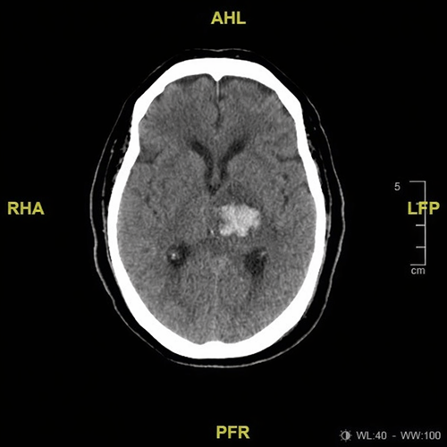 Tomografía axial de cráneo simple que muestra hemorragia intraparenquimatosa en región talámica izquierda, visible como una zona hiperdensa bien delimitada, con discreto efecto de masa local. Hallazgos compatibles con evento vascular cerebral hemorrágico de etiología hipertensiva.