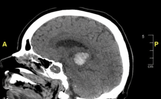 Neumonía por Pneumocystis jirovecii complicada con barotrauma en paciente con VIH: caso clínico