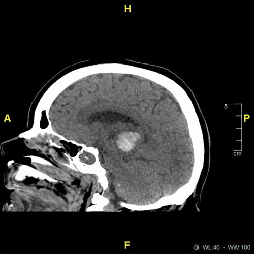 Tomografía de cráneo en corte sagital que evidencia lesión hiperdensa en región talámica izquierda, compatible con hemorragia intraparenquimatosa, con discreto efecto de masa sobre estructuras adyacentes. Hallazgos sugestivos de evento vascular cerebral hemorrágico de probable origen hipertensivo.