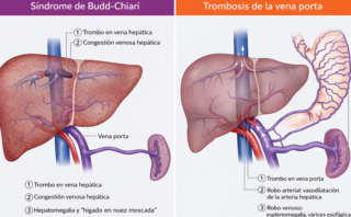 Hipertensión portal