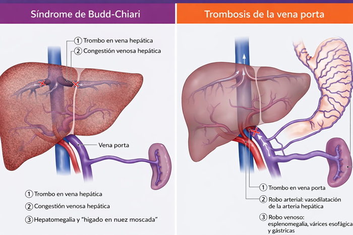 Comparación esquemática entre el síndrome de Budd-Chiari y la trombosis de la vena porta. A la izquierda, el síndrome de Budd-Chiari se caracteriza por trombosis de las venas hepáticas, lo que condiciona congestión venosa hepática, hepatomegalia y el clásico aspecto de “hígado en nuez moscada”. A la derecha, la trombosis de la vena porta provoca obstrucción del flujo portal con desarrollo de circulación colateral, vasodilatación arterial hepática compensatoria y manifestaciones de hipertensión portal como esplenomegalia y várices esofagogástricas